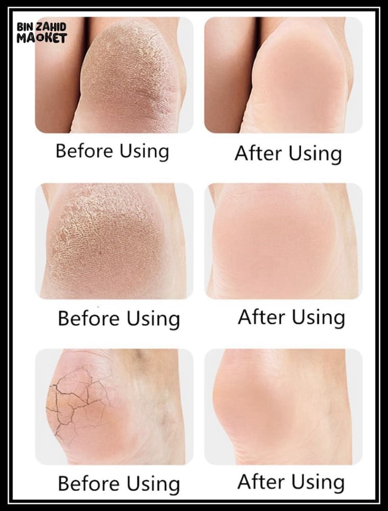 SET OF ANTI-CRACK HEAL SET